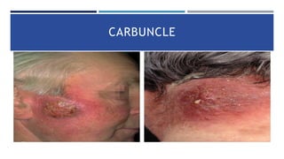 BACTERIAL INFECTIONS OF SKIN overview .pptx