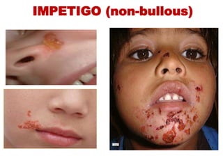 IMPETIGO (non-bullous)
 