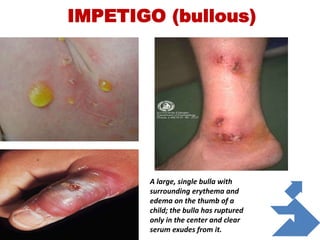 IMPETIGO (bullous)
A large, single bulla with
surrounding erythema and
edema on the thumb of a
child; the bulla has ruptured
only in the center and clear
serum exudes from it.
 