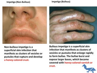 Non-bullous impetigo is a
superficial skin infection that
manifests as clusters of vesicles or
pustules that rupture and develop
a honey-colored crust.
Bullous impetigo is a superficial skin
infection that manifests as clusters of
vesicles or pustules that enlarge rapidly
to form bullae. The bullae burst and
expose larger bases, which become
covered with honey-colored varnish or
crust.
Impetigo (Bullous)Impetigo (Non-Bullous)
 