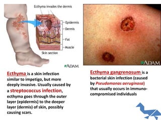 Ecthyma gangrenosum is a
bacterial skin infection (caused
by Pseudomonas aeruginosa)
that usually occurs in immuno-
compromised individuals
Ecthyma is a skin infection
similar to impetigo, but more
deeply invasive. Usually caused by
a streptococcus infection,
ecthyma goes through the outer
layer (epidermis) to the deeper
layer (dermis) of skin, possibly
causing scars.
 