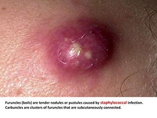 Furuncles (boils) are tender nodules or pustules caused by staphylococcal infection.
Carbuncles are clusters of furuncles that are subcutaneously connected.
 