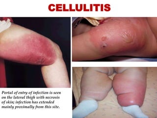 CELLULITIS
Portal of entry of infection is seen
on the lateral thigh with necrosis
of skin; infection has extended
mainly proximally from this site.
 