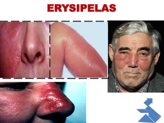 ERYSIPELAS
 