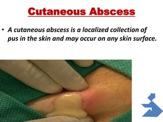 Cutaneous Abscess
• A cutaneous abscess is a localized collection of
pus in the skin and may occur on any skin surface.
 