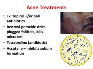 Acne Treatments
• Tx: topical +/or oral
antibiotics.
• Benzoyl peroxide dries
plugged follicles, kills
microbes
• Tetracycline (antibiotic)
• Accutane – inhibits sebum
formation
 