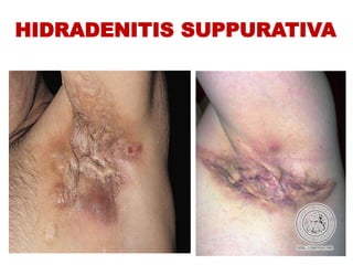 HIDRADENITIS SUPPURATIVA
 