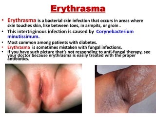 Erythrasma
• Erythrasma is a bacterial skin infection that occurs in areas where
skin touches skin, like between toes, in armpits, or groin .
• This intertriginous infection is caused by Corynebacterium
minutissimum.
• Most common among patients with diabetes.
• Erythrasma is sometimes mistaken with fungal infections.
• If you have such picture that’s not responding to anti-fungal therapy, see
your doctor because erythrasma is easily treated with the proper
antibiotics.
 