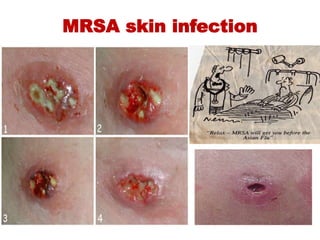 MRSA skin infection
 