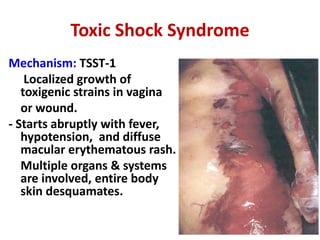 Toxic Shock Syndrome
Mechanism: TSST-1
Localized growth of
toxigenic strains in vagina
or wound.
- Starts abruptly with fever,
hypotension, and diffuse
macular erythematous rash.
Multiple organs & systems
are involved, entire body
skin desquamates.
 