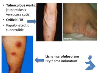 • Tuberculous warts:
[tuberculosis
verrucosa cutis]
• Orificial TB
• Papulonecrotic
tuberculide
Lichen scrofulosorum
Erythema induratum
 
