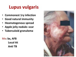 Lupus vulgaris
• Commonest 1ry infection
• Good natural immunity
• Heamatogenous spread
• Apple jelly nodule--scar
• Tuberculoid granuloma
Mx: bx, AFB
Local ttt
Anti TB
 