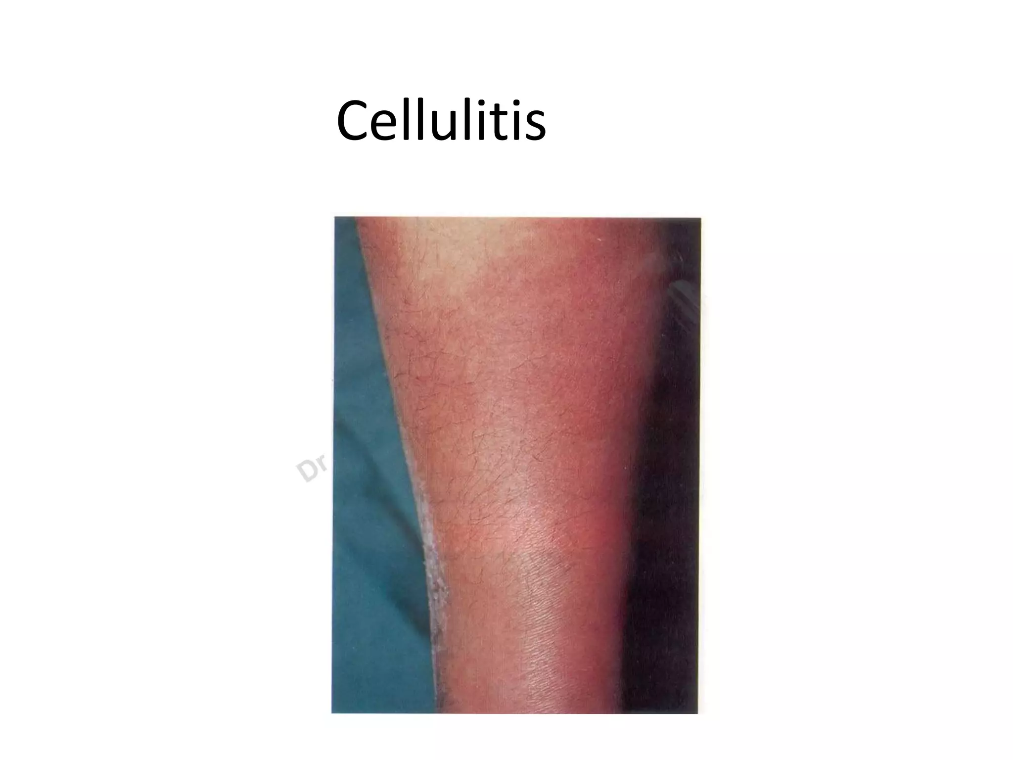Bacterial infections of the skin | PPT