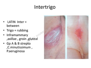 Bacterial infections of the skin | PPT