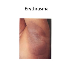 Bacterial infections of the skin | PPT