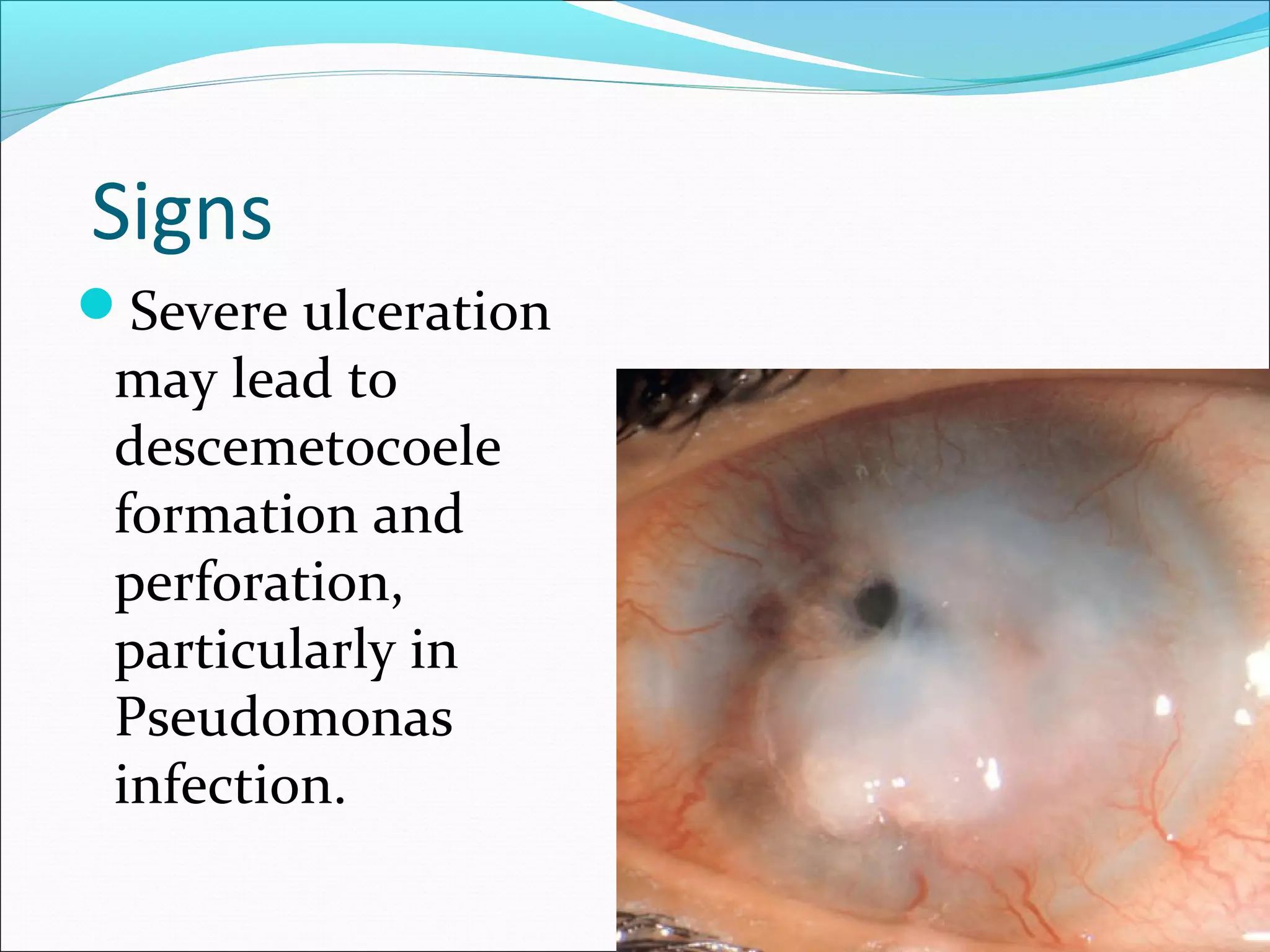 Signs
Severe ulceration
may lead to
descemetocoele
formation and
perforation,
particularly in
Pseudomonas
infection.
 
