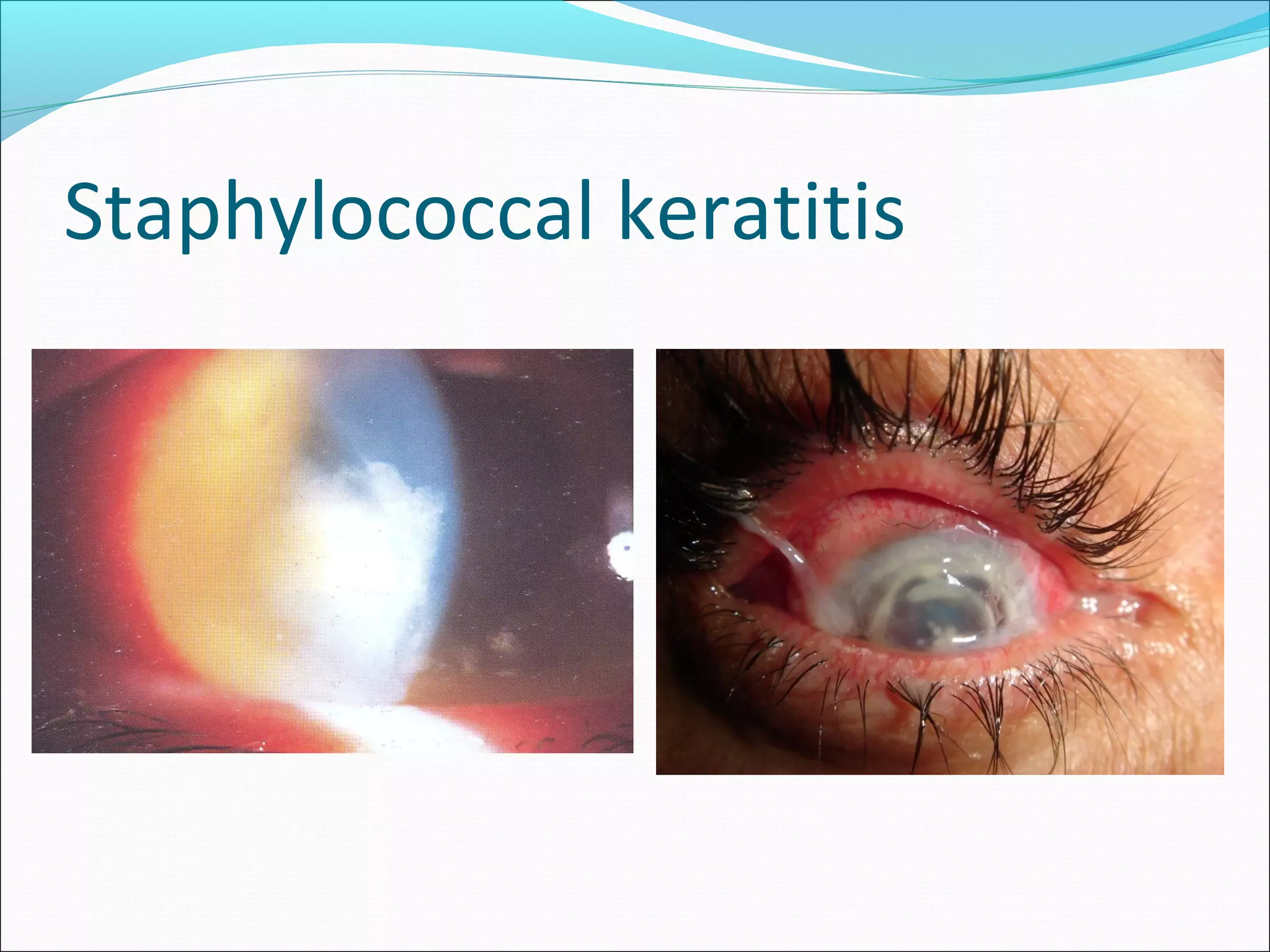 Staphylococcal keratitis
 