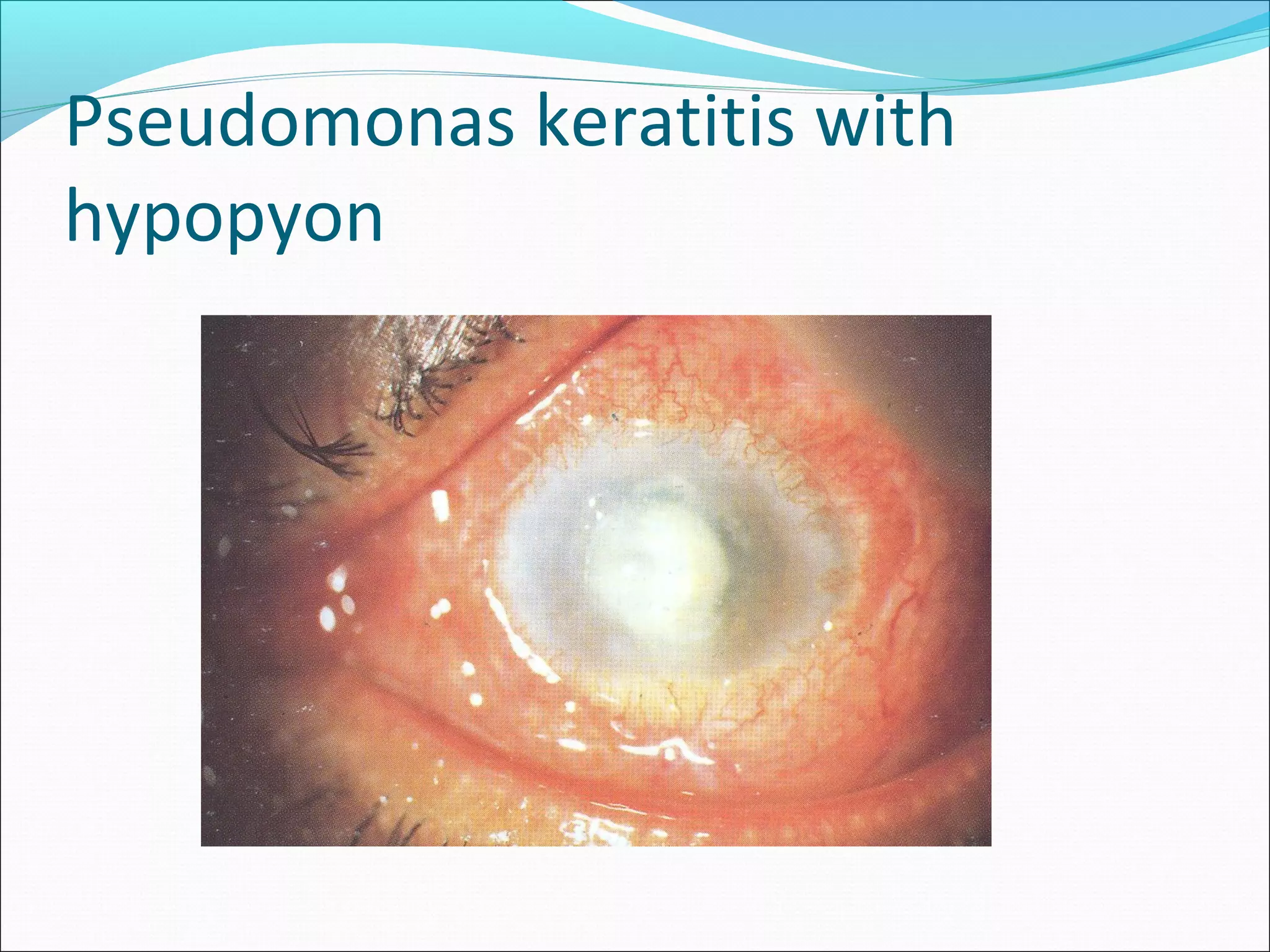 Pseudomonas keratitis with
hypopyon
 