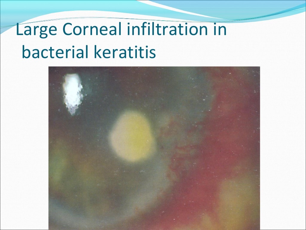 Bacterial keratitis