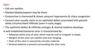 Signs :
• Lids are swollen.
• Marked blepharospasm may be there
• Conjunctiva is chemosed & shows conjunct hyperaemia & ciliary congestion.
• Corneal ulcer usually starts as an epithelial defect associated with greyish-
white circumscribed infiltrate (seen in early stage).
• The epithelial defect & infiltrate enlarges & stromal oedema develops.
A well established bacterial ulcer is characterized by :
• Yellowish-white area of ulcer which may be oval or irregular in shape.
• Margins of the ulcer are swollen and over hanging.
• Floor of the ulcer is covered by necrotic material.
• Stromal oedema is present surrounding the ulcer area
 