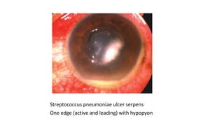 Streptococcus pneumoniae ulcer serpens
One edge (active and leading) with hypopyon
 