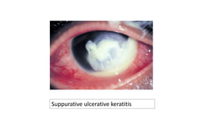 Suppurative ulcerative keratitis
 