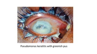 Pseudomonas keratitis with greenish pus
 