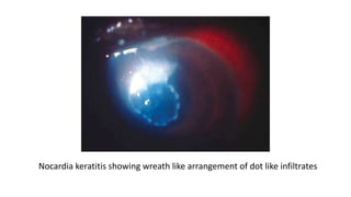 Nocardia keratitis showing wreath like arrangement of dot like infiltrates
 
