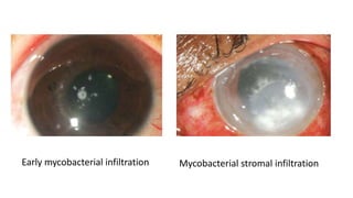 Early mycobacterial infiltration Mycobacterial stromal infiltration
 