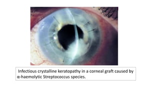 Infectious crystalline keratopathy in a corneal graft caused by
α-haemolytic Streptococcus species.
 