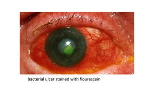 bacterial ulcer stained with flourescein
 