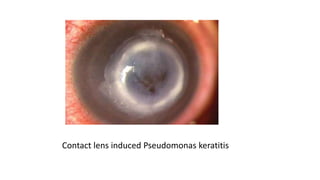 Contact lens induced Pseudomonas keratitis
 