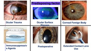 Predisposing factor
Ocular Trauma Ocular Surface
Disease
Corneal Foreign Body
Immunosuppressiv
e Agents
Postoperative Extended Contact Lens
Use 4
 