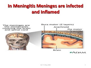 In Meningitis Meninges are infected
           and Inflamed




               Dr.T.V.Rao MD          3
 