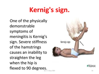 Kernig's sign.
One of the physically
demonstrable
symptoms of
meningitis is Kernig's
sign. Severe stiffness
of the hamstrings
causes an inability to
straighten the leg
when the hip is
flexed to 90 degrees.
                    Dr.T.V.Rao MD   30
 