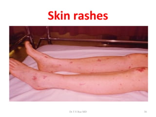 Skin rashes




   Dr.T.V.Rao MD   38
 