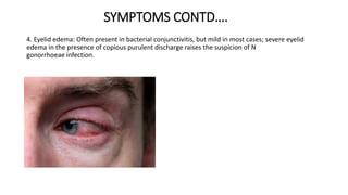 SYMPTOMS CONTD….
4. Eyelid edema: Often present in bacterial conjunctivitis, but mild in most cases; severe eyelid
edema in the presence of copious purulent discharge raises the suspicion of N
gonorrhoeae infection.
 