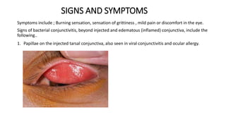 SIGNS AND SYMPTOMS
Symptoms include ; Burning sensation, sensation of grittiness , mild pain or discomfort in the eye.
Signs of bacterial conjunctivitis, beyond injected and edematous (inflamed) conjunctiva, include the
following..
1. Papillae on the injected tarsal conjunctiva, also seen in viral conjunctivitis and ocular allergy.
 