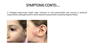 SYMPTOMS CONTD….
3. Enlarged preauricular lymph node: Common in viral conjunctivitis and unusual in bacterial
conjunctivitis, although found in severe bacterial conjunctivitis caused by N gonorrhoeae.
 