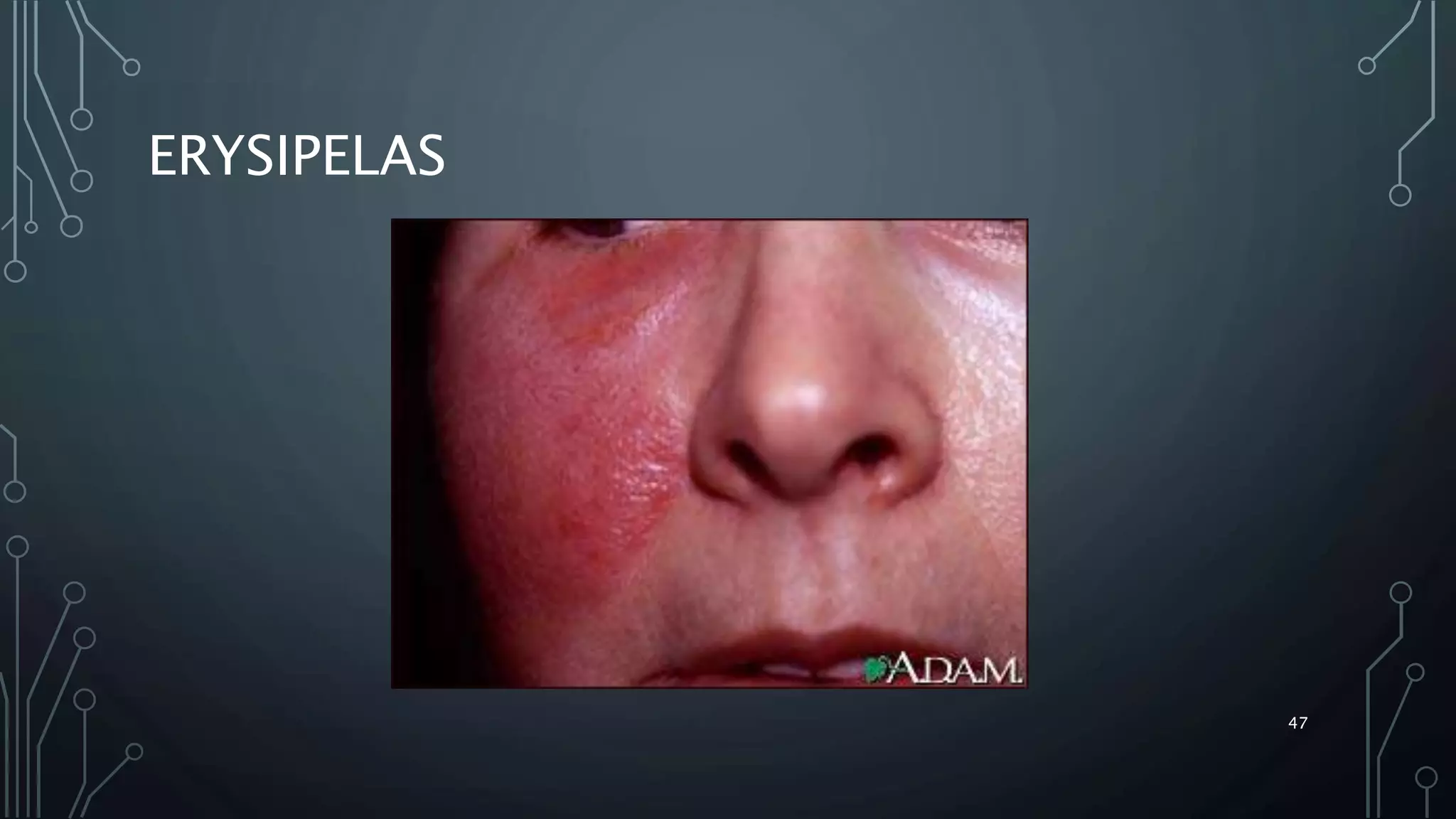 Bacterial skin infection- dermatology | PPTX