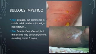 Bullous Face Bacterial skin infection- dermatology | PPTX