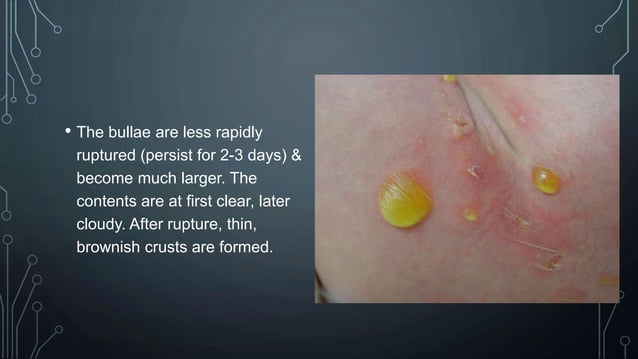 Bacterial skin infection- dermatology | PPTX