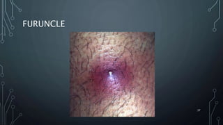 Bacterial skin infection- dermatology | PPTX
