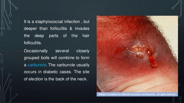 Bacterial skin infection- dermatology