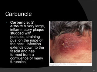 Bacterial skin infection jaber | PPT