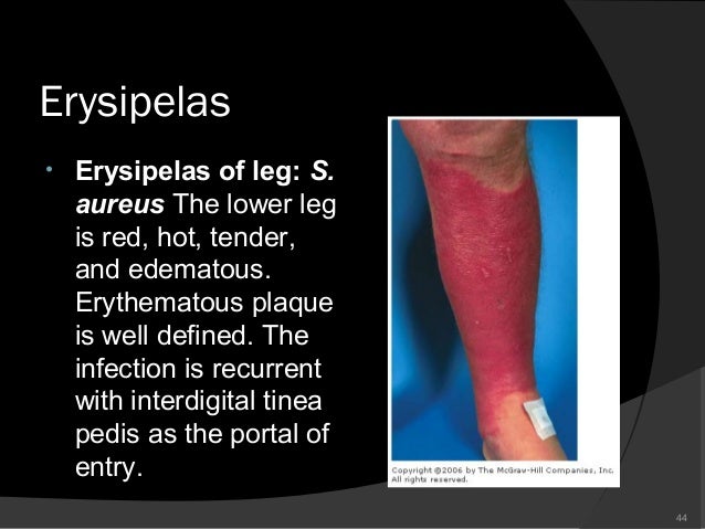 b skin strep treatment infection infection skin Bacterial jaber