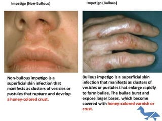 Bacterial skin infections | PPTX