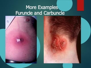 Carbuncle Examples Comprehensive Overview of Bacterial Skin Infections: Diagnosis and ...