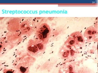 Streptococcus pneumonia
32
 