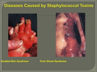 Scalded Skin Syndrome Toxic Shock Syndrome
 